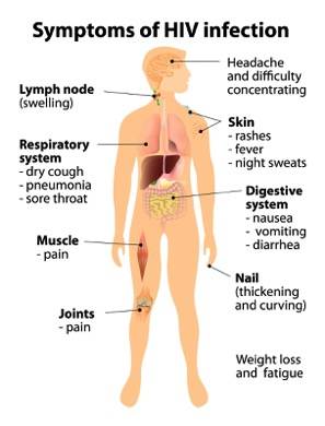 Symptoms of Hiv and Aids